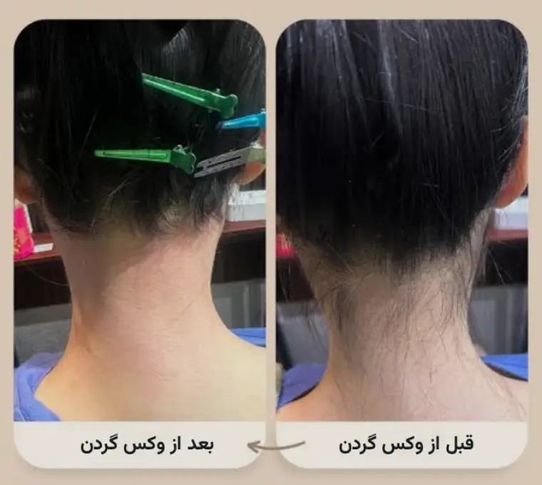 حذف موهای زائد پس از وکس گردن